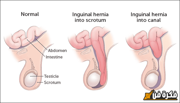 اعراض الفتق الأربي عند الرضع