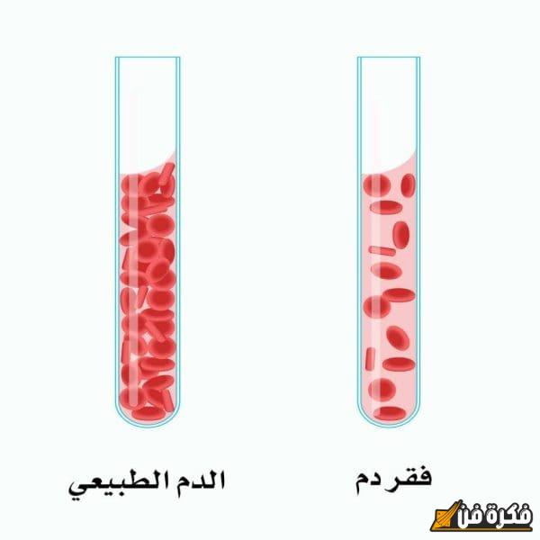 بحث شامل عن فقر الدم مع المراجع: الأسباب، الأعراض، وطرق العلاج الفعالة