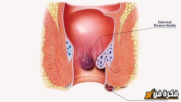 علاج البواسير الداخلية في المنزل: طرق طبيعية وفعّالة لتخفيف الألم واستعادة الراحة الدائمة!