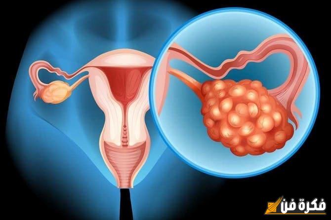 اكتشف العلاج الطبيعي الفعّال لكيس دموي على المبيض بالأعشاب: خطوة towards الصحة والشفاء!