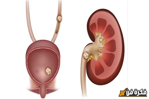 كم مدة خروج الحصى من الكلى؟ اكتشف الجوانب المهمة والمفاجآت المتعلقة بهذه العملية الحيوية!