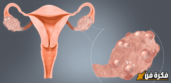 شكل التكيس على المبيض بالصور: اكتشف التفاصيل المدهشة والتغيرات الصحية المهمة!